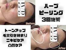 ラヴレボーテ(La Vraie Beaute)/ハーブピーリング3回