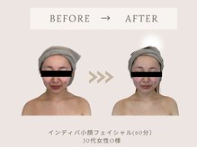 フェリチタトウキョウ(Felicita Tokyo)/インディバフェイシャル60分