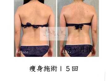 アイ エステサロン(Ai)/【20代】ブライダルダイエット♪