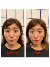 しろくま整体院 鷺ノ宮阿佐ヶ谷院/美容鍼♪