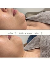 シルキーエービューティー(Silky A Beauty)/レモンボトルであご下スッキリ