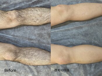 エリクサー 熊谷店(Elixir)/Before After