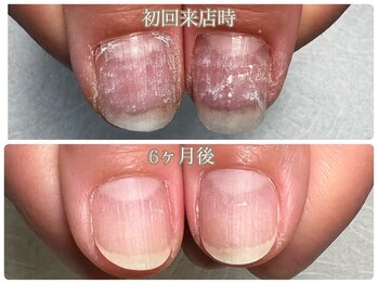 ルドネ ヴィ アシヤ(Redonner vie Ashiya)/傷んだ爪を健康な爪に育爪コース