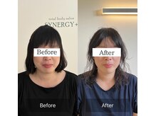 シナジープラス(SYNERGY+)/１年美容鍼に通った結果
