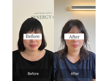 シナジープラス(SYNERGY+)/1年美容鍼に通った結果