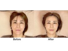 こじま 富雄団地接骨院/ヒト幹細胞美容鍼