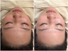 マヴィ 高槻店(MavY.)/ツヤ肌×リフトアップ