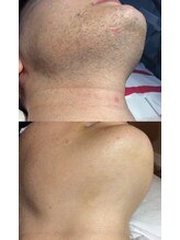 柑楠(カナウ)/ヒゲ脱毛で清潔感アップ