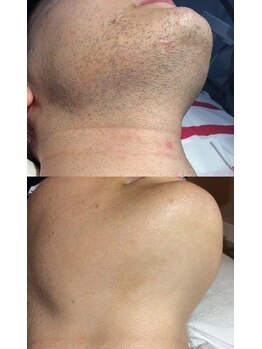 柑楠(カナウ)/ヒゲ脱毛で清潔感アップ