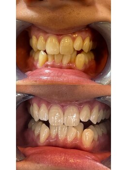 アレッド 大阪店(ared.)/ホワイトニング