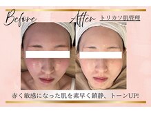 リーズリアン(Rises Lien)/【BeforeAfter】トリカソ肌管理