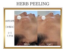 ロージー(ROSY)/ハーブピーリング/阿南/徳島