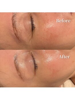 ウルソワン 都島店(/ulu soin)/シワの改善