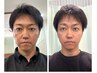 初回限定【むくみ・リフトアップ・肌悩みに◎】メンズ美容鍼 4000円→2980円