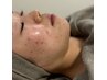 【２回目以降の方】ハーブピーリング《顔》ニキビ・赤み・肌トラブル