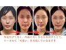 【初回限定3回券/30％オフ！】お肌悩み改善鬼ルート美容鍼33000円→23100円