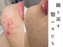 ジョンミー(JONMEE)の雰囲気(毛穴縮小には韓国最新ダクトピール!銀座一丁目.東銀座.宝町)