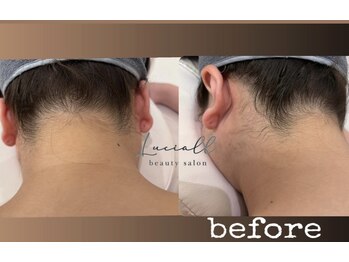 ルシアル(LUCIALL)/うなじ脱毛before
