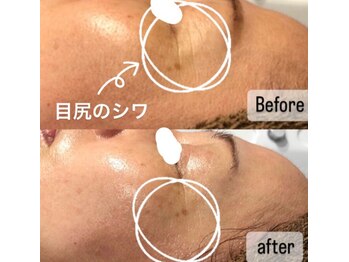 エム(M)/シワケアには輪郭デザイン!!