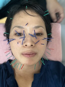 あいはなの写真/【美容鍼×手技の小顔エステで内側から輝く美しさを♪】施術後すぐに感じるフェイスラインの変化！持続性◎