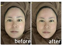 アランプスパ(ARNHP-Spa)/生コラーゲンリフトアップコース