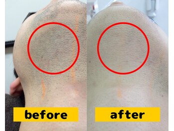 ボディステップ 調布(BODYSTEP)/フルフェイス脱毛