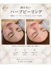 アンフィア(Anfia)/剥けないハーブピーリング