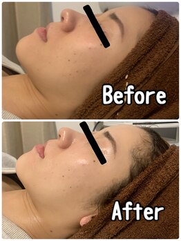 ブランシュール/ハイドラ×小顔タイト