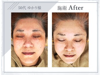 サロンドゥレーヴシエル(Salon de reve Ciel...)/【微細針“肌改革プログラム”】