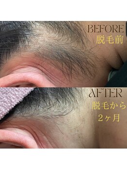 ランプシー(Lampsi)/うなじ脱毛