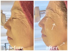 ルー ハナレ 神戸岡本 摂津本山店(Luu HANARE)/小顔リフトアップ　しわ改善