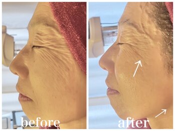 ルー ハナレ 神戸岡本 摂津本山店(Luu HANARE)/小顔リフトアップ　しわ改善