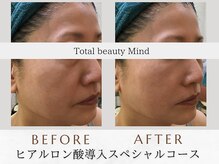 トータルビューティー マインド(Total Beauty)/《ヒアルロン酸導入セラピー》