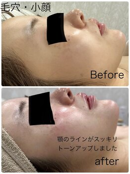 ルミネル 名古屋新栄(Luminelle)/小顔矯正