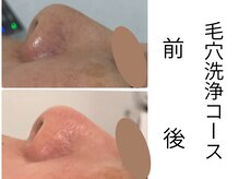 カリアンヌ/やっぱり毛穴はキレイにね！