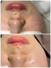 チュチュ(TUTU)/剥離無しハーブ