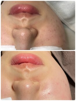 チュチュ(TUTU)/剥離無しハーブ