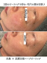 エヌプラス(N+)/50代女性＊ピーリング2回後(2)