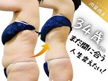セレブリボーン 大阪ボーテ