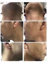 イフヒアー(if here)/【左】脱毛前　【右】4回目