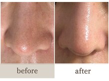 アイビー(ivy)/【毛穴洗浄】before/after