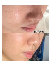 リリベル(LilyBell)/Before After