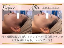 リーズリアン(Rises Lien)/【BeforeAfter】アクアピール