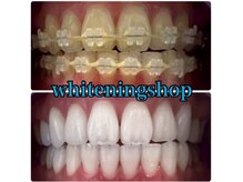 ホワイトニングショップ 豊橋店(WHITENING SHOP)/Before&After豊橋ホワイトニング