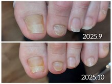 爪切り屋 足楽/【自爪育成】剥離爪をサポート