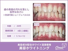 クレア(Crea)/【ホワイトニング症例写真】