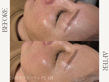 ルカ 北堀江(Luca)/シミくすみ集中ケア