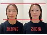 【小顔矯正/顔の歪み/エラ張り】写真で変化を確認!美容小顔整体¥13200→¥5500