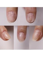 ビーエルシー ネイルサロン(BLC nail salon)/爪のコンプレックス解消