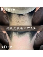 エピナ 秋田店(Epina)/うなじMIX脱毛★